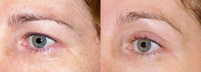 45-54 year old woman treated with Thermage - 1 month after Thermage eyes