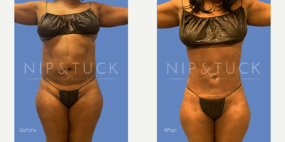 35-44 year old woman treated with Liposuction - Vaser lipo 360 + lipo of inner thighs with Renuvion Weight: 203 lbs Height: 5'8 BMI: 30.9