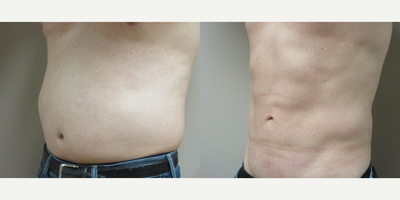 Tumescent Liposuction for Men - Patient is 33 years old and wanted to improve the abdomen and hip area with Tumescent Liposuction. Great six pack result !