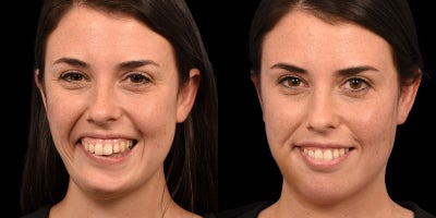 35-44 year old woman treated with Facial Reconstructive Surgery - Before & After Asymmetric Crying Facies Correction: Permanent Facial Reanimation Surgery for Congenital Unilateral Lower Lip Palsy (CULLP)