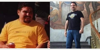 Man treated with Gastric Sleeve Surgery - Man treated with Gastric Sleeve Surgery.