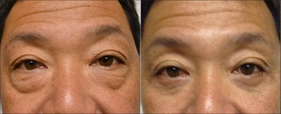 Blepharoplasty - Male shown before and after lower lid blepharoplasty with muscle sling