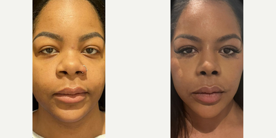 Woman treated with Rhinoplasty, African American Rhinoplasty - Patience truly pays off! While it can take 1-2 years for the nose to fully settle after rhinoplasty especially for those with thicker skin remarkable changes often emerge within just a month.Take a look at this transformation post-op 1 month. We performed an open rhinoplasty, enhancing the dorsum and the tip with rib cartilage to achieve a beautifully balanced profile.