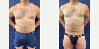 35-44 year old woman treated with SAFELipo - 40-45-year-old male who struggled with resistant excess fat despite a healthy lifestyle and physically hard career.Procedure: S.A.F.E. liposuction of upper/lower abdomen, hips, waist, and chest.