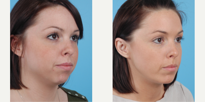 23 year old woman treated with Chin Liposuction - 23 year old woman treated with Chin Augmentation, combined with tumescent Chin/Neck Liposuction