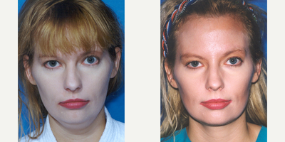 32 year old woman treated with Chin Liposuction - 32 year old woman treated with endoscopic Brow Lift combined with tumescent Chin/Neck Liposuction and jaw-line