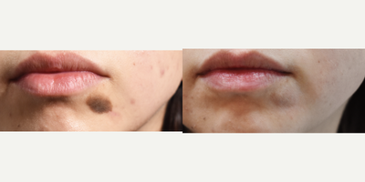 Mole Birthmark removal before after Profractional laser resurfacing. - Young patient had a very visible larger nevi (mole/birthmark) that she wanted removed from the chin.  With this type of birthmark, we have only found the fractional laser (Sciton Profractional) to be effective.  Several treatments are required.