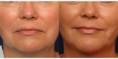 Woman treated with Chin Surgery - Woman treated with Chin Surgery using implant