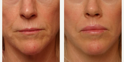 Woman treated with Chin Surgery - Woman treated with Chin Surgery using implant