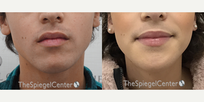 18-24 year old transgender woman treated with Jaw Surgery - 18-24 year old transgender woman treated with Jaw Surgery