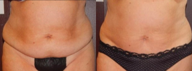 55-64 year old woman treated with UltraSlim  - UltraSlimis more effective than Coolsculpting and has immediate results. The photos below are from 6 treatments each. You can see a difference in the shape of the body, the tightness, the contouring and even the skin looks younger in both after photos. This is non-surgical and non-invasive and can be done during a lunch break.