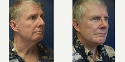 65-74 year old woman treated with Chin Implant - This patient was treated with a chin implant, neck lift, liposuction of the neck, and rhinoplasty.