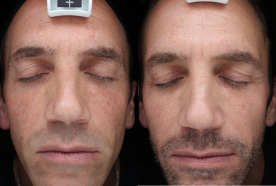 35-44 year old man treated with Melasma Treatment - Depigmentation Peel for Melasma & Hyperpigmentation
