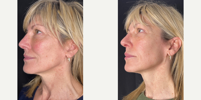 Woman treated with Sylfirm X - Woman treated with Sylfirm X