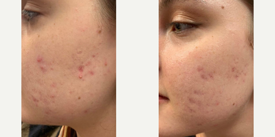 Woman treated with Sylfirm X - Woman treated with Sylfirm X