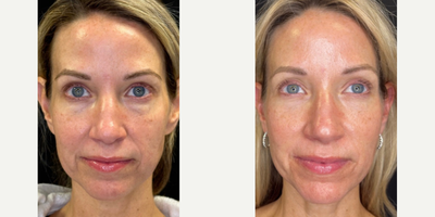 Woman treated with Sylfirm X - Woman treated with Sylfirm X
