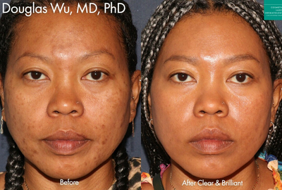 Woman treated with Clear and Brilliant - Clear and Brilliant to treat brown spots by Dr. Wu