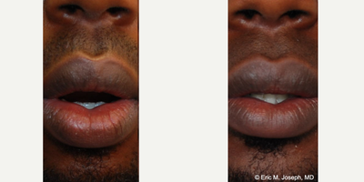 18-24 year old man treated with Lip Reduction - Our handsome 21 year old patient was self conscious about the appearance of his lower lip. He felt that it was droopy, and that there was too much pink mucous membrane showing while his mouth was open. These photos demonstrate a natural looking lower lip appearance 10 months after lower lip reduction surgery. His scar is invisible on the inside of his lower lip, and you can see less droopiness and less pink mucous membrane showing.