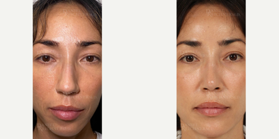 Woman treated with Asian Rhinoplasty - Woman treated with Asian Rhinoplasty