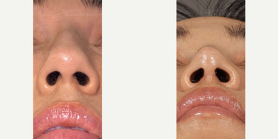 Woman treated with Asian Rhinoplasty - Woman treated with Asian Rhinoplasty