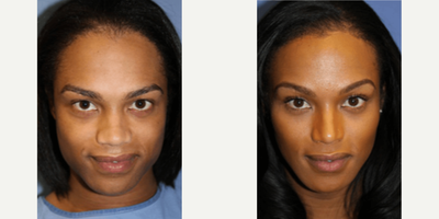 Woman treated with Brow Lift - Woman treated with Brow Lift