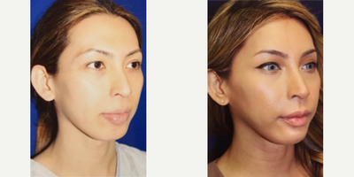 Woman treated with Brow Lift - Woman treated with Brow Lift