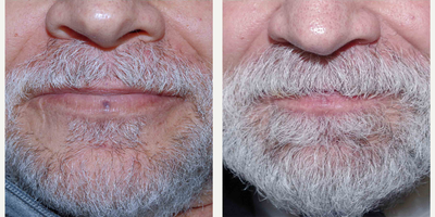 55-64 year old man treated with Laser Treatment - 64 year old male was treated with Cynosure (IPL) for a lower lip lesion; photos depict the patient's results 1 month post-fourth treatment.