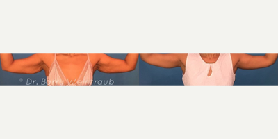 Woman treated with Arm Lift - Woman treated with Arm Lift