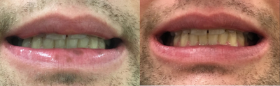 35-44 year old man treated with Pico Genesis - Patient treated with Picogenesis on the lip for Labial Melanotic Macules.