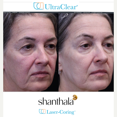 UltraClear  Laser-Coring  by Dr. Shanthala - Laser-Coring with UltraClear laser ( never had any fillers or botulinum toxin ) has helped improve her acne scarring, peri-orbital rejuvenation, and fuller cheeks & youthful results performed by MD only.