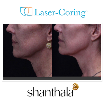 UltraClear Laser & Laser-Coring by Dr. Shanthala - Laser-Coring with UltraClear Laser was performed after Cheek volume correction, under eye fillers & lip fillers on the same day by Dr. Shanthala