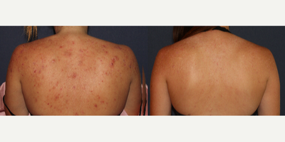 25-34 year old woman treated with ResurFX - Woman treated with Infini RF and Resurfx for back acne.