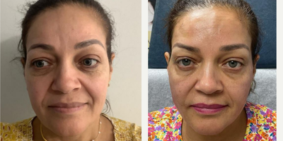 45-54 year old woman treated with Microneedling, PRP Injections, Cheek Fillers, RHA Collection Fillers - Patient first did Skin Pen Microneedling + PRP to face one session then took half of RH4 applied to one cheek and then applied other half to other cheek very natural results