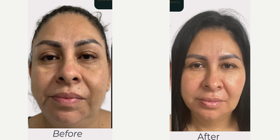 35-44 year old woman treated with Radiesse, Microneedling, SkinPen, PRP Injections, Cheek Fillers - Patient first started with microneedling with skin pen then we applied topically to her face prp 2 weeks later we did radiesse injection for cheek, marionette came out natural looking