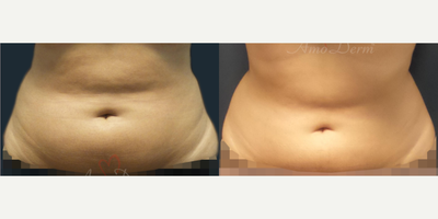 25-34 year old woman treated with SculpSure - Non-surgical removal of stubborn fat in belly and flanks with SculpSure (compare with CoolSculpting)
