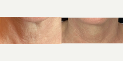 45-54 year old woman treated with Opus Plasma - This client wanted to address her fine lines and wanted to stimulate collagen to help decrease the signs of aging. This is 3 weeks after her second Opus treatment!