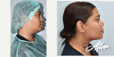 25-34 year old woman treated with Kybella, Aqualyx, Botox - i did double chin removal and marking jawline.