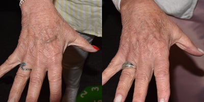 55-64 year old woman treated with Radiesse - Radiesse to hands