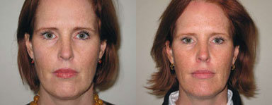 Injectables - 1. Botox to the Eyebrow Region 2. Evolence to the Jawline 3. Evolence Breeze to the lips