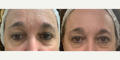 Woman treated with TempSure Envi - Woman treated with TempSure Envi