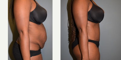 25-34 year old woman treated with Tummy Tuck - This 32 year old mother of two has been pregnant five times. She had a very wide separation of her abdominal muscles, (rectus diastasis). She weighs 156 pounds and is 53 tall. She had a tummy tuck with liposuction to the flank area which removed 2 pounds and 300 cc respectively. Her results are shown early at just 2 months; already the scar looks great.