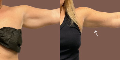 35-44 year old woman treated with AirSculpt+ - Patient received AirSculpt+ which is fat removal with additional skin tightening on their arms. Results are 3 months post-op