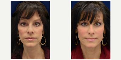 45-54 year old woman treated with Non Surgical Face Lift - Voluma