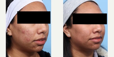 18-24 year old woman treated with SkinPen - After 2 sessions of SkinPen microneedling, this patient is on their way to smoother, clearer skin, with a noticeable reduction in acne scars. Her results are shown after 1 month after her second session. She is getting one more session and will have more improvement.