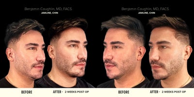 25-34 year old man treated with Jaw Surgery, Chin Implant - 25-34 year old man treated with Jaw Surgery and Chin Implant, resulting in a more masculine structure.