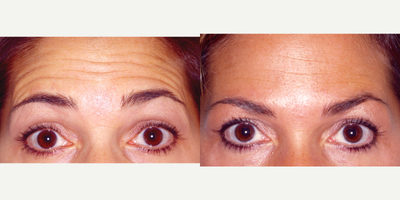 35-44 year old woman treated with Botox - 44 year old with deep wrinkles of the forehead. With 2 weeks of selective and micro-Botox to the brows and forehead it is smoother and relaxed.