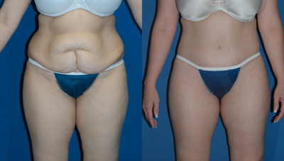 Circumferential body lift - Circumferential body lift