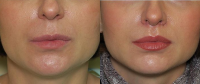 Woman treated with Lip Surgery - Woman treated with Lip Surgery