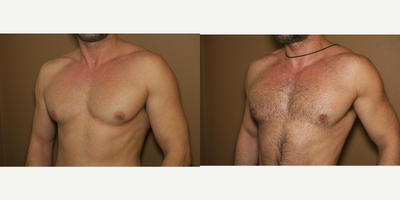 25-34 year old man treated with Gynecomastia Surgery - gynecomastia correction