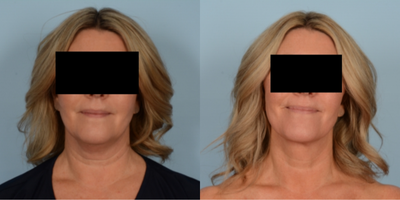 45-54 year old woman treated with Renuvion - Renuvion: Neck